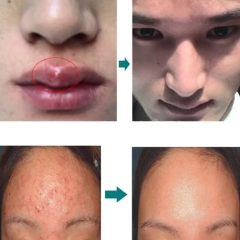 

30g Face Cream Beauty Product Face Skin Repairing Acne Cream Oil Control Acne Remover Facial Skin Care Hot Mdf