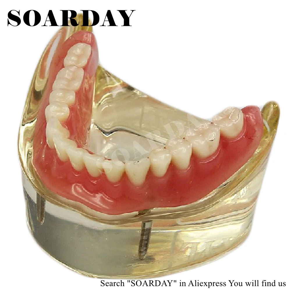 SOARDAY Dental Lower Removable Overdenture Inferior with 2 implants Demonstration Teeth Anatomy Pathology Dentistry Tooth Model SOARDAY Dental Lower Removable Overdenture Inferior with 2 implants Demonstration Teeth Anatomy Pathology Dentistry Tooth Model