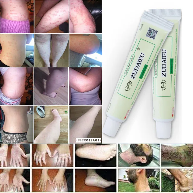 3 шт. Zudaifu крем для ухода за кожей, крем для лечения псориаза кожи, крем для лечения псориаза, дерматита, экзематоида, мази, крем для лечения псориаза