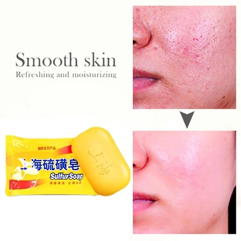

Cheapest New 1PCS Sulfur Soap Treat Itching Acne Psoriasis Mite Dermatitis