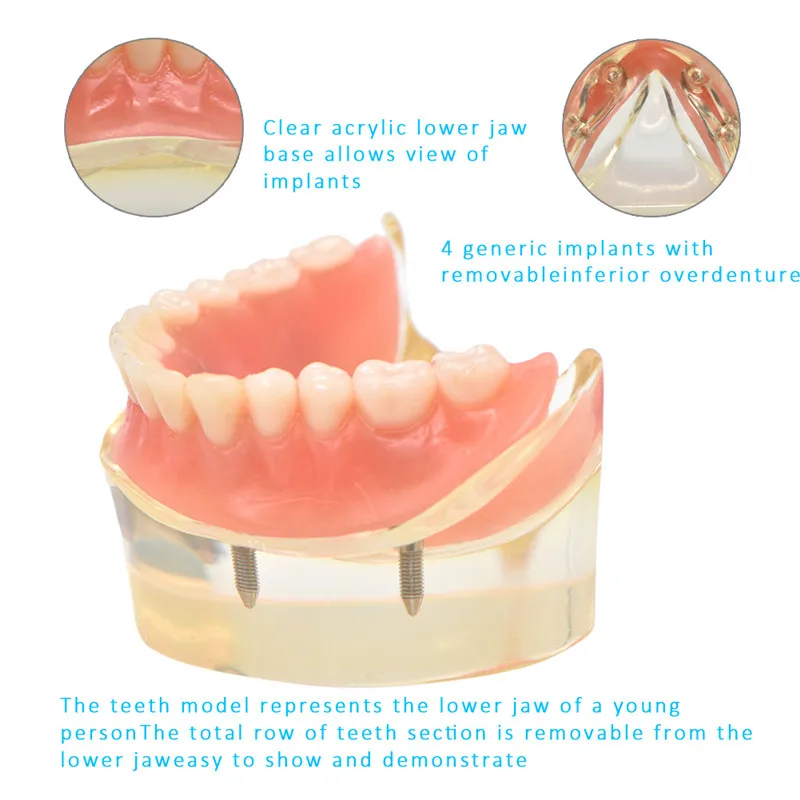 Dental Overdenture Teeth Model Removable Interior Mandibular Lower Teeth Model Mandibular with Implant for Tooth Teaching Study Dental Overdenture Teeth Model Removable Interior Mandibular Lower Teeth Model Mandibular with Implant for Tooth Teaching Study