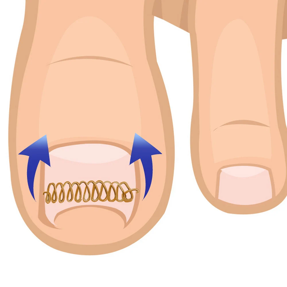 3 шт./компл. вросшие ногти для ног "францзуский маникюр" коррекции Сталь крюк фиксаж провода лента паронихии корректор для большого пальца стопы можно педикюра инструмент