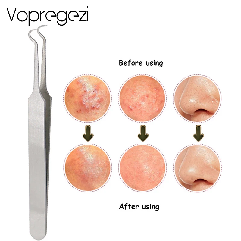 

Vopregezi Blackhead Acne Removal Needle Tweezers Pimple Comedone Extractor Stainless Steel Black Head Remover Tool Face Care