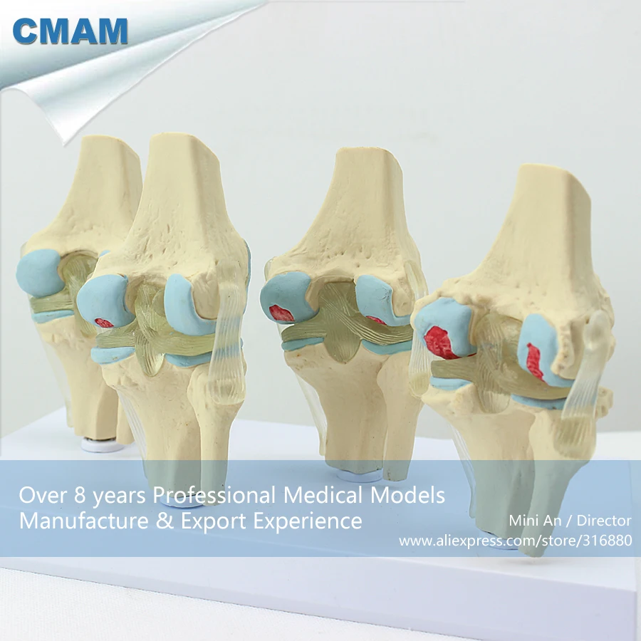 12359/человека 4-х ступенчатый остеоартрит колена комплект совместное Исследование модели, медицинские товары образования анатомические модели