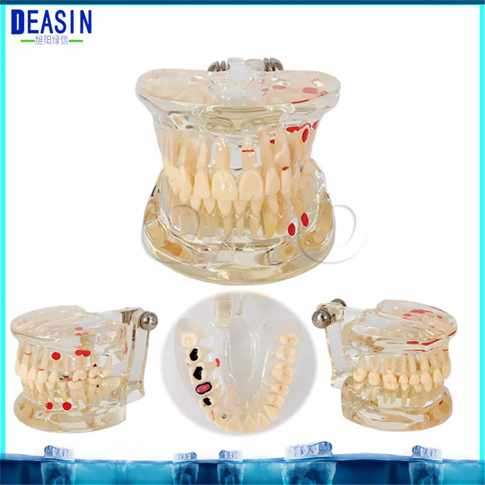 Dental Implant Teeth Dental Pathological Teeth Implant Model Teaching Teeth Model & Restoration Bridge Tooth dental implant biomaterials