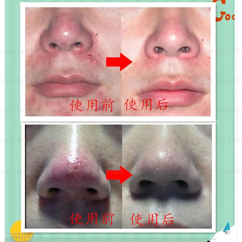 Rosacea Treatment Face Cream Chinese Herbal Red Nose Acne Remover Face Clean Face Care Redness Flushing Vaselines Acne Treatment Aliexpress