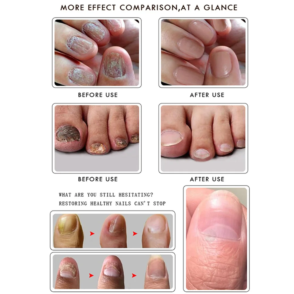 RtopR восстанавливающая эссенция для ногтей сыворотка имбирь Лечение ногтей от грибка удаление онихомикоза ноготь питательный Осветляющий уход за руками