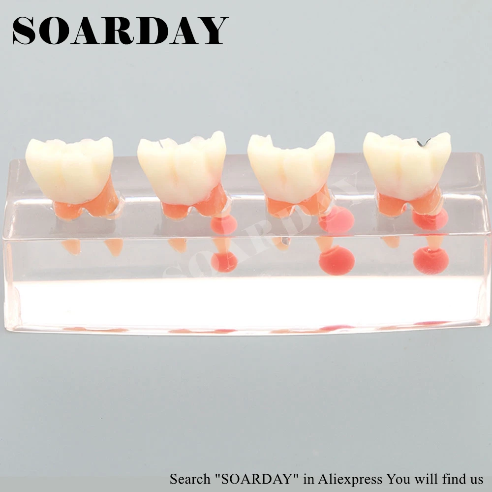 Dental Endodontic Restoration Model (1)