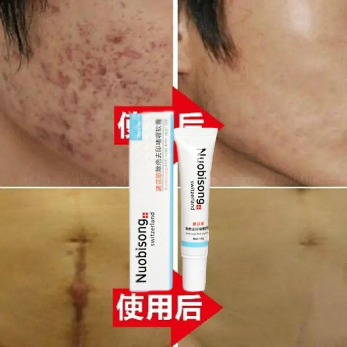 2 шт./лот Nuobisong удаление лицевого рубца Striae Gravidarum корректор пигментации против