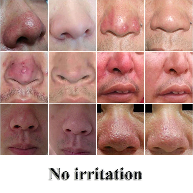 rode neus rosacea