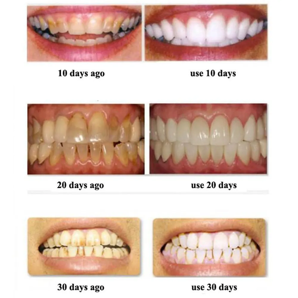 28 шт./14 пар, 3D отбеливающие полоски для зубов, стоматологические инструменты, виниры для зубов, белый гель, отбеливающие зубные полоски для ложных зубов, полоска для зубов, улыбка