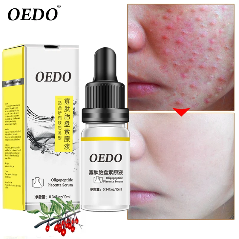 OEDO олигопептид плацента акне Омолаживающая эссенция для кожи жидкость для удаления акне для восстановления кожи лица Отбеливание тонких пор