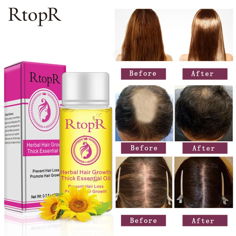 RTOPR Herbal Hair Growth Anti Hair Loss Liquid Promote Thick Fast Hair Growth Treatment Essential Oil Health Care Essence TSLM1