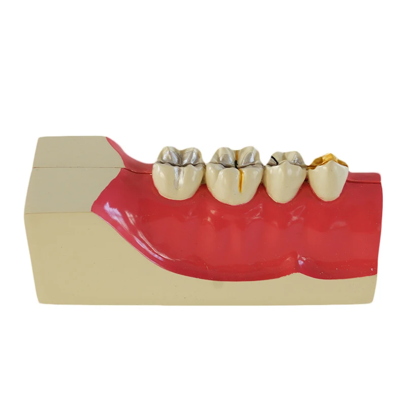 

Sagitally Sectioned Model Dental Oral Anatomical Model Typodont
