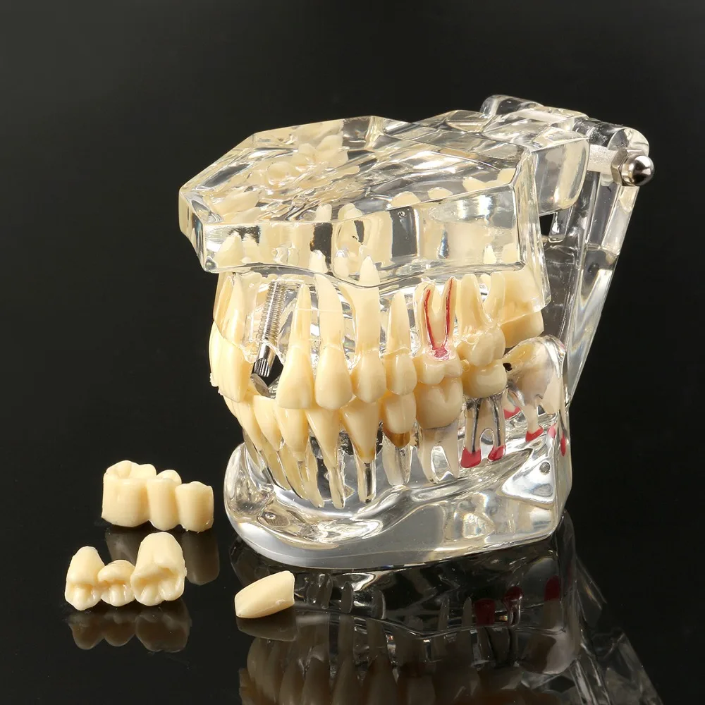 

Dental Implant Disease Teeth Model With Restoration Bridge Tooth Dentist For Medical Science Dental Disease Teaching Study
