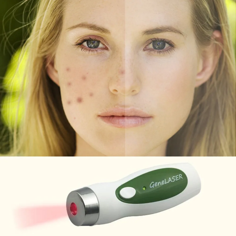 5mW low level laser therapy Anti Aging Scars Acne Laser Removal Facial