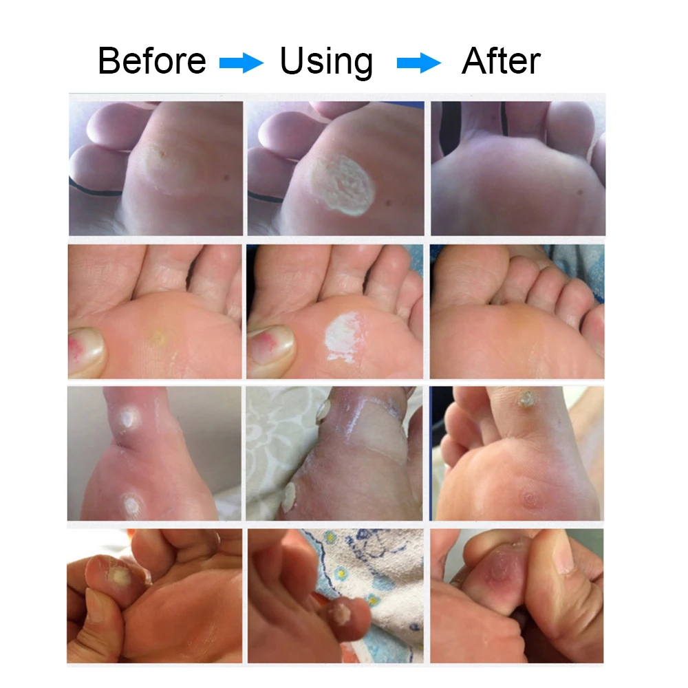 6 12 18pcs Foot Warts Remove Corn Remover Massager Medical Plaster Calluses Plantar Foot Care Thorn 4
