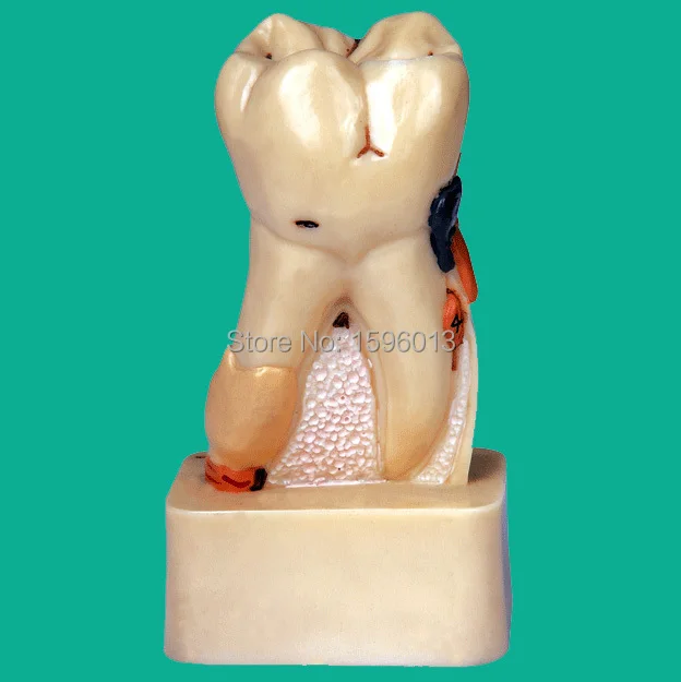 Dissected Model of Dental Disease, dental disease pathology decomposition model Dissected Model of Dental Disease, dental disease pathology decomposition model