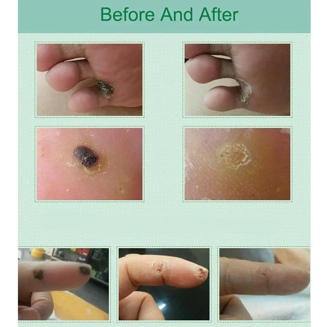 50 piezas de yeso de maíz sin dolor removedor de maíz pies cuidado de color caqui verrugas parche de yeso de espino para pies 50 piezas de yeso de maíz sin dolor removedor de maíz pies cuidado de color caqui verrugas parche de yeso de espino para pies