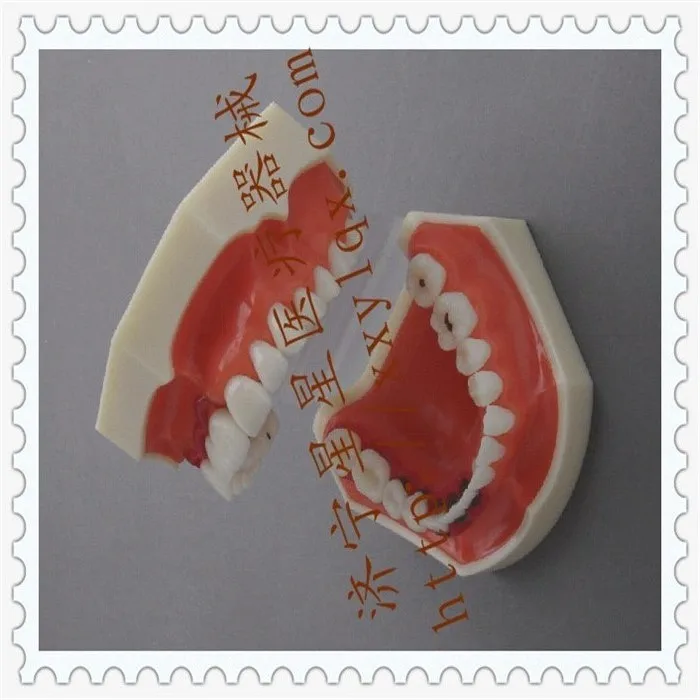 

Patient communication Dental teaching model 12.6cm*7.8cm*6.2cm Periodontal Disease model Oral model free shipping
