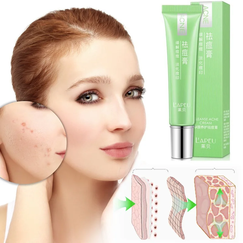15g Acne Cream Anti Acne Treatment Scar Removal Gel ...