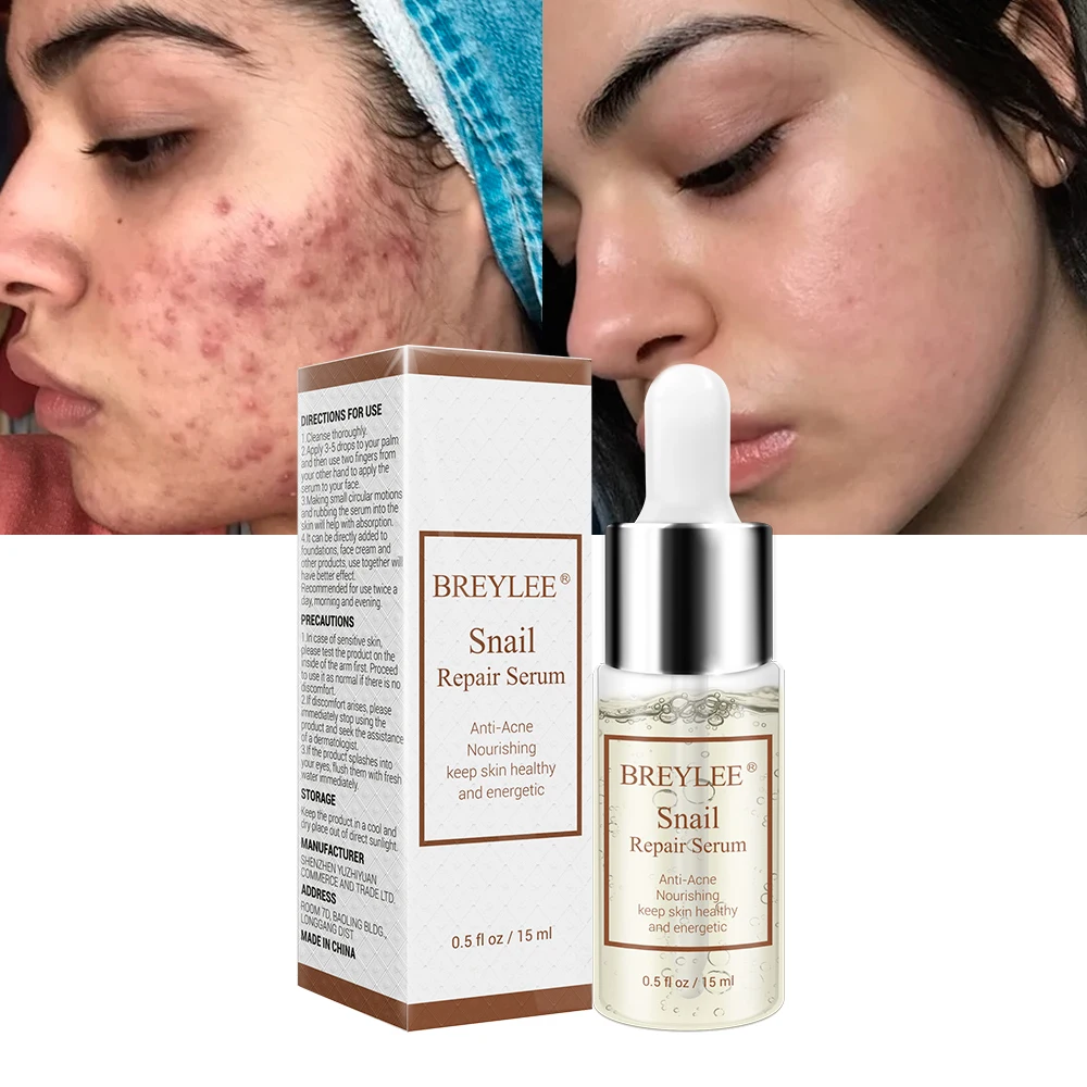 

BREYLEE Snail Repairing Serum Anti-Acne Rejuvenation Essence Scars Acne Treatment Liquid Face Skin Care Nourishing Moisturizing