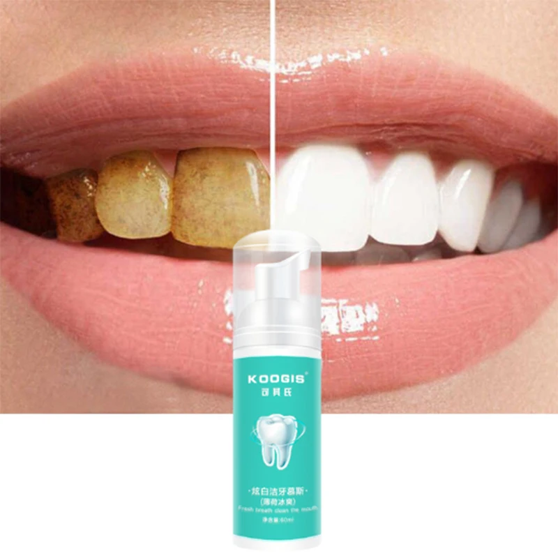 Perla pluma blanqueamiento blanqueador dental clareador limpieza herramientas tandsteen verwijderaar limpieza diente blanchiment dentaire