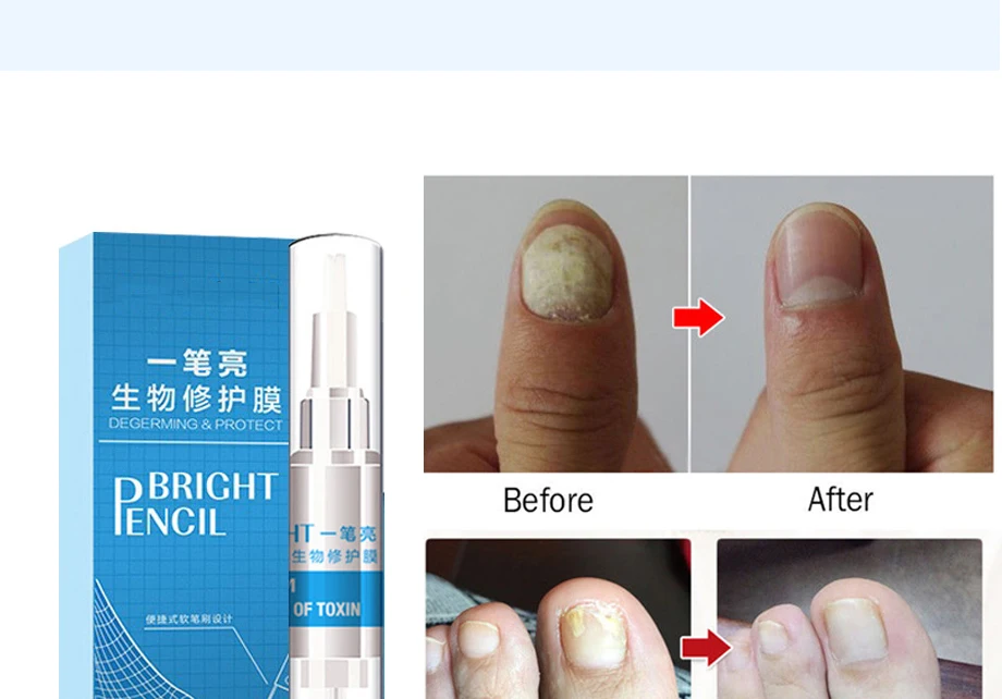 Раствор анти фонжик инфекция ногтей Яркий карандаш грибковое лечение анти гриб биологический ремонт 3 мл восстанавливает здоровые ногти