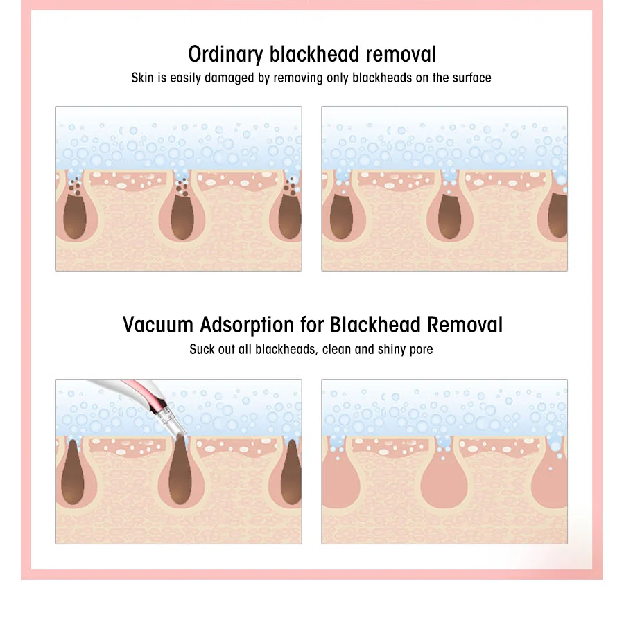 AOPHIA удаления черных точек уход за кожей поры, акне удаления прыщей вакуумный всасывающий инструмент с 6 головками лица машина для очистки лица