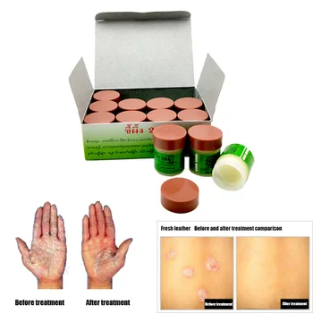 

29A Psoriasi Eczma Cream Works Perfect For All Kinds Of Skin Problems Patch