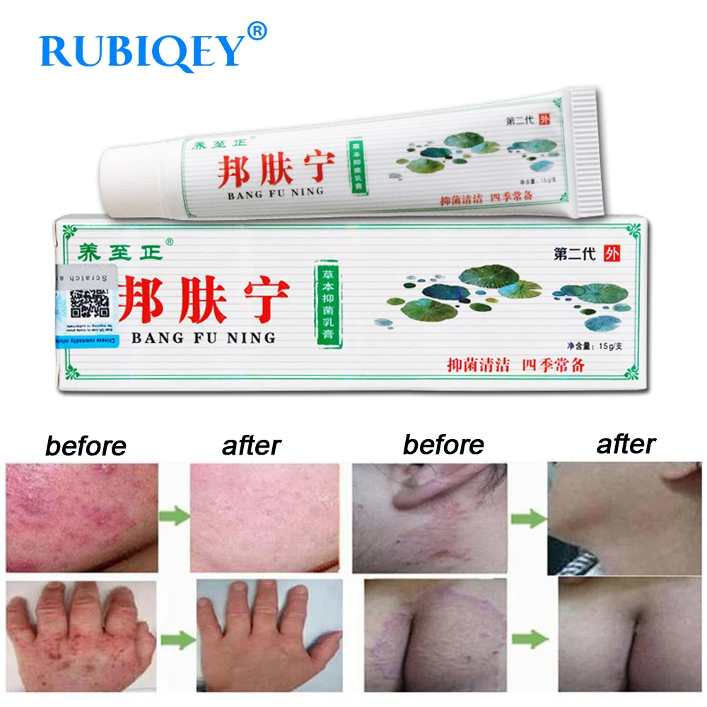 

Chinese Body Psoriasis Cream Health Care Products Eczema Psoriasis Ointment Herbal Skin Massage Cream RUBIQEY