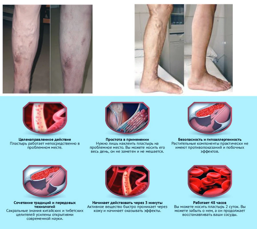 5X паук вены крем против варикозного расширения вен для ног-китайская медицина для вены от бедной ноги плохой циркуляции ног нет необходимости в хирургии