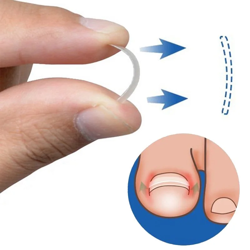 Наклейка для коррекции вросших пальцев ног, патчи, корректор пароникьи, пилочка, эластичная заплатка, корректор для ухода за ногами, лечение педикюра