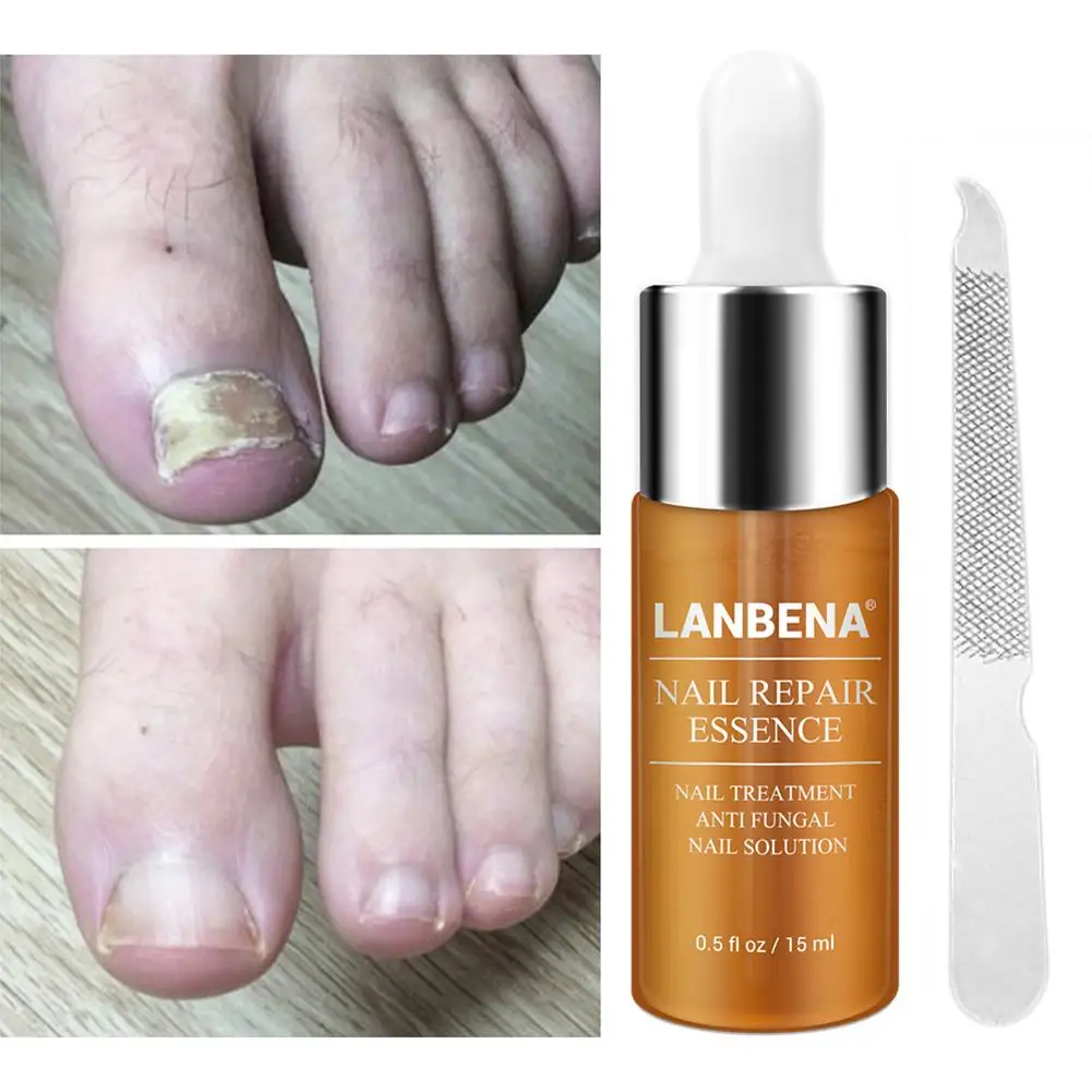 Cheap Offer for  Nail Repair Essence Serum Fungal Nail Treatment Remove Onychomycosis Toe Nail Nourishing Brightenin