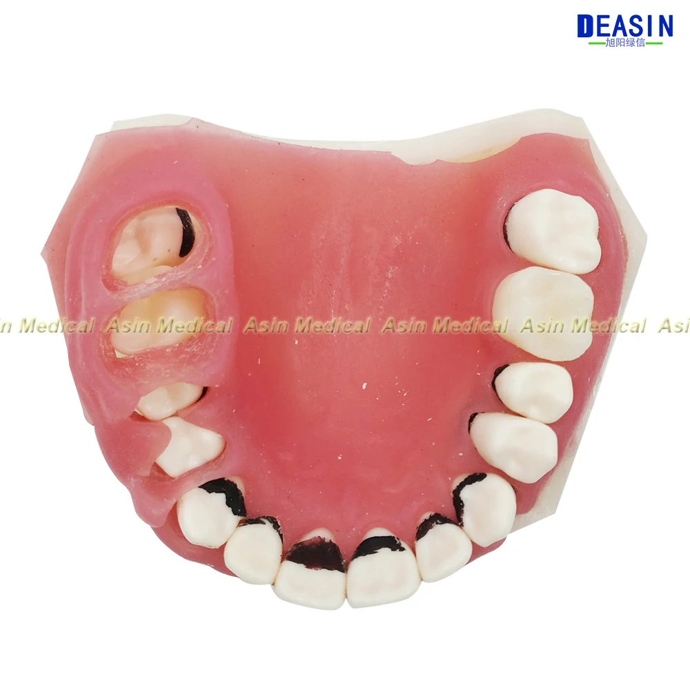 Новинка модель для изучения заболеваний Стоматологическая модель|dental periodontics|dental