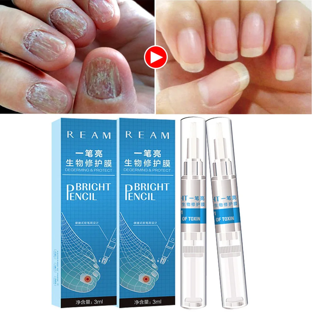 

3ML Nail Fungus Treatment Nail Oil Pen Anti Fungal Nail Infection Cuticle Remover Liquid Nail Growth Skin Care