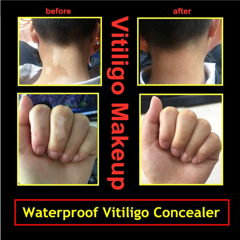 

Hidden Skin Vitiligo Waterproof Long-lasting Natural White Spots Camouflage Makeup Pen on Face Arm Body for Women Men 1pc/lot