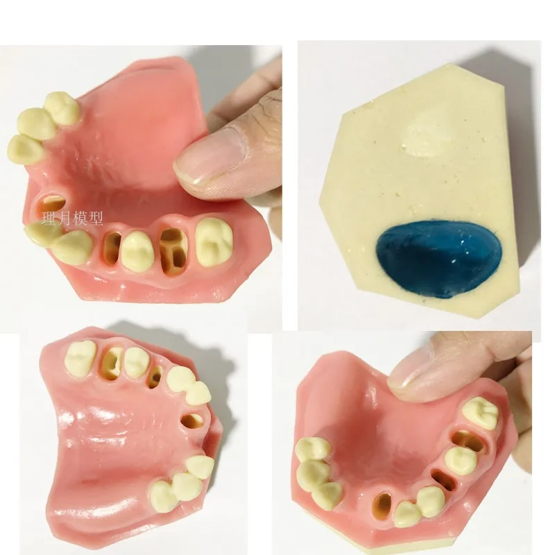 Стоматологические материалы модель орального имплантата хирургические maxillary sinus Стоматологические принадлежности оборудование инструменты мягкие десны