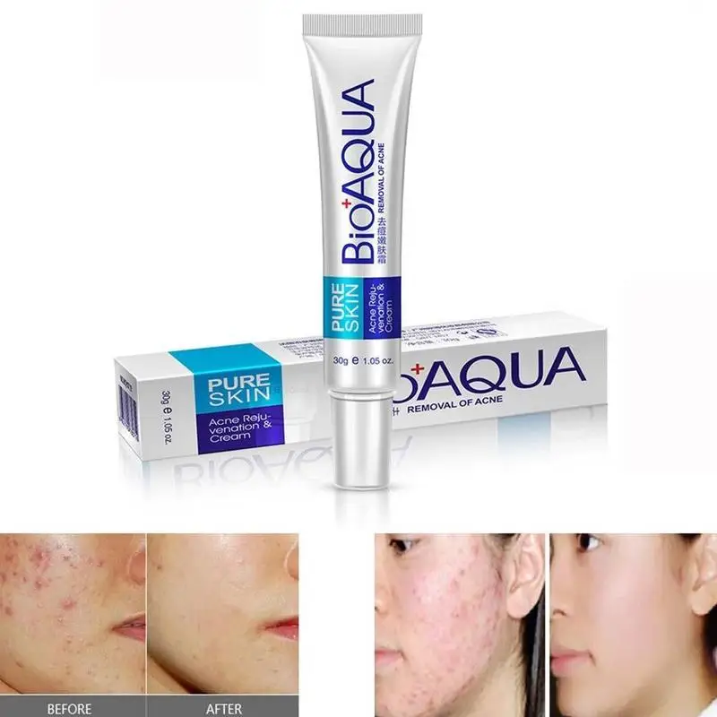 

BIOAQUA Face Cream Whitening Skin Care Anti Acne Treatment Cream Oil Control Moisturizing Acne Scar Remover Pores Acne Cream 30g