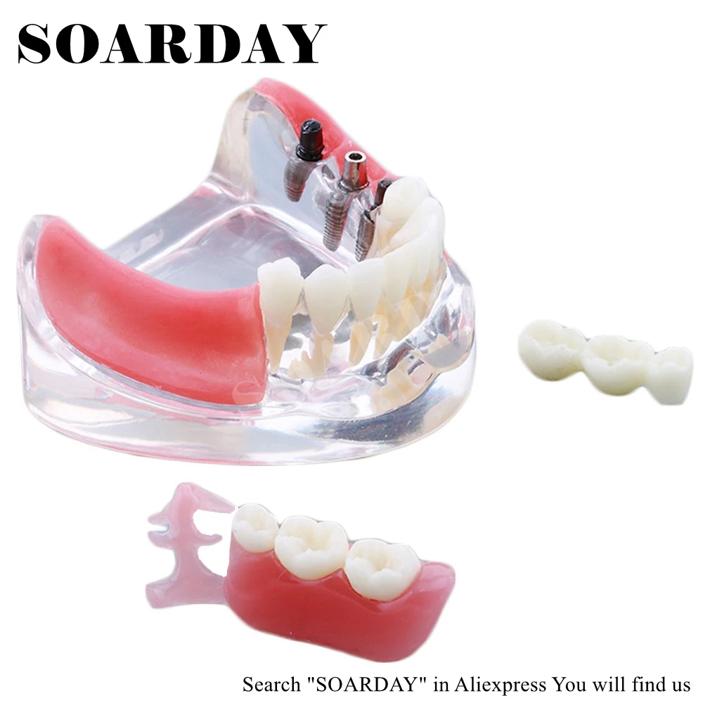 Implant & Restoration Model (4)