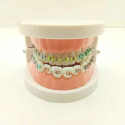 Dental Orthodontic Treatment Model With Ortho Metal Ceramic Bracket Arch Wire Buccal Tube Ligature Ties