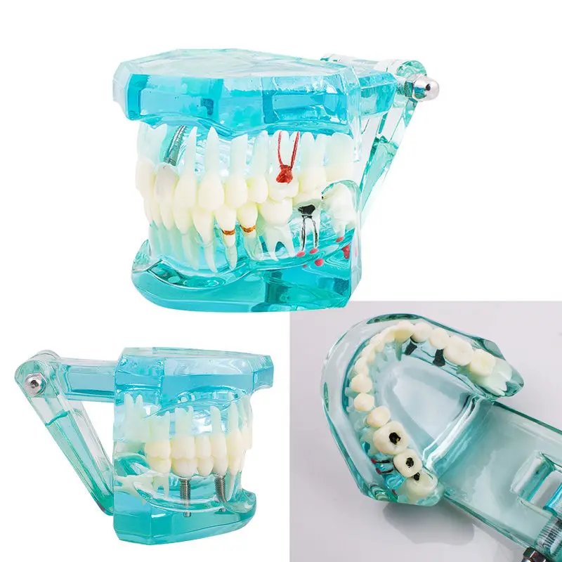 

Dental Study Tooth Model Adult Pathological teaching Teeth model new denshine