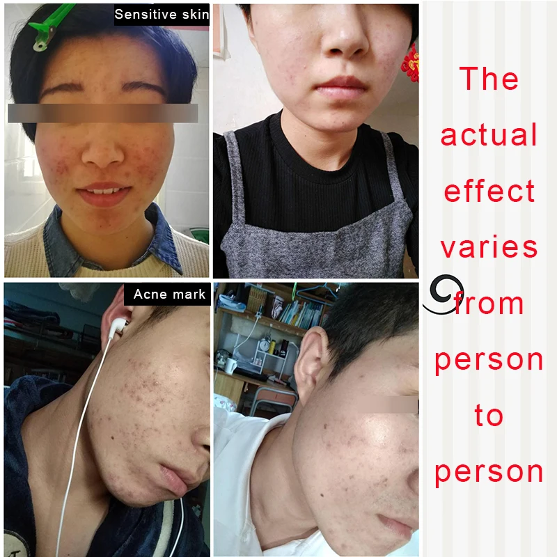 “ Peeling com Ácido 10% Glicólico Glicólico Peel