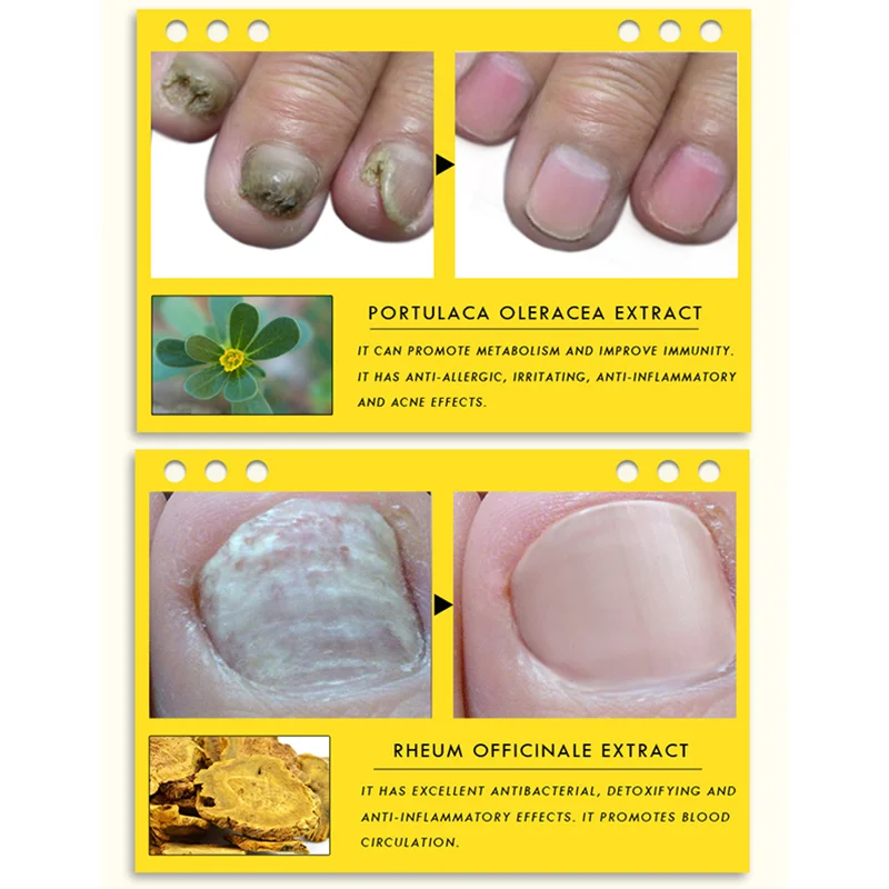 Hot Sale Ginseng Antibacterial Nail Treatments Essential Oil Nails Fungus Repair Foot Nail Care jlrs2018