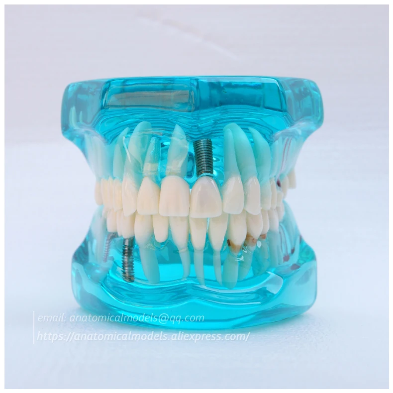 13069 Restoration with Implant 3 