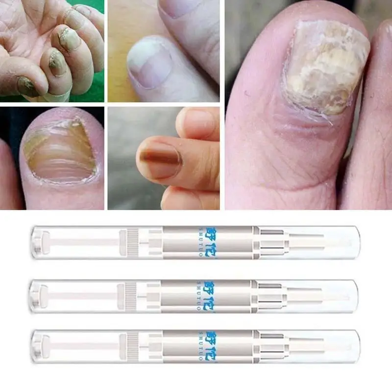 Хороший результат лечения Ногтей ручка онихомикоз пароникья анти грибковая