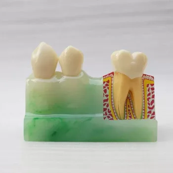 

Dental 4 Times Tooth Disassembling Model