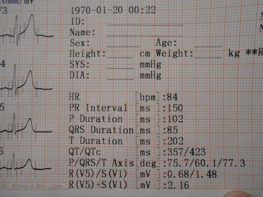 3 Channels Ekg Machine 80mm 20m Per Roll Ecg Thermal Recording
