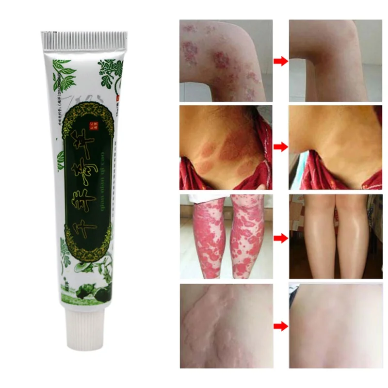 

Psoriasis Creams Dermatitis Eczema Pruritus Psoriasis Ointment Body Cream