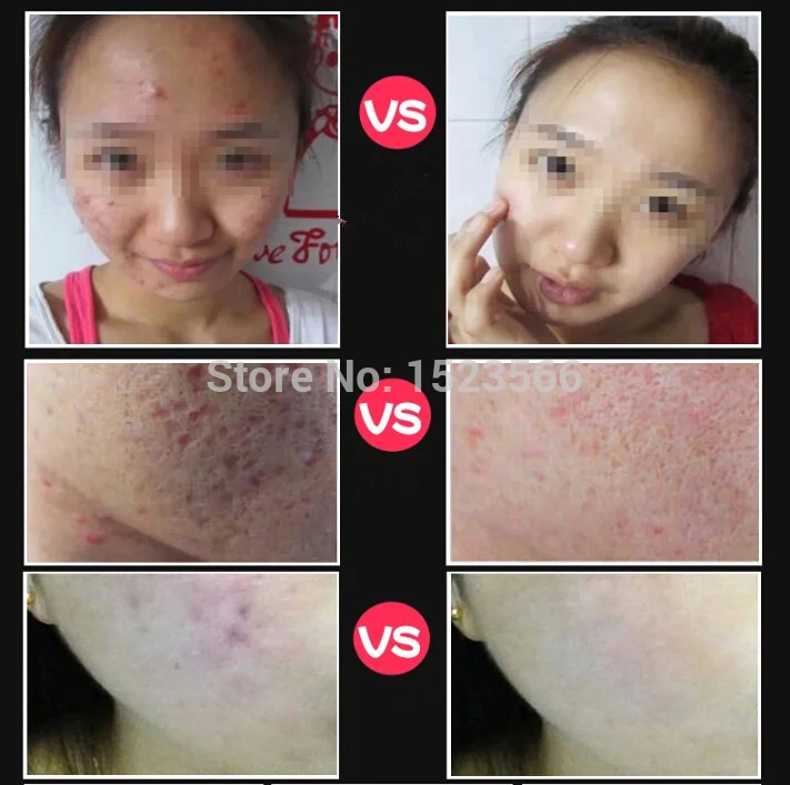 Harga Akarz Merek Terkenal Alami Aromaterapi Minyak Esensial Lavender Jerawat Bekas Luka Perbaikan Membantu Tidur Perawatan Kulit Pelangsing Minyak Lavender Beli Akarz Merek Terkenal Alami Aromaterapi Minyak Esensial Lavender Jerawat Bekas Luka Perbaikan Membantu Tidur Perawatan Kulit Pelangsing Minyak Lavender